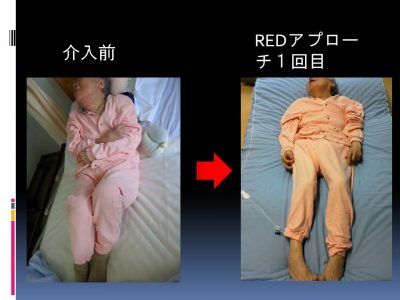 脳内の耳石の反応を利用した新しいリハビリ