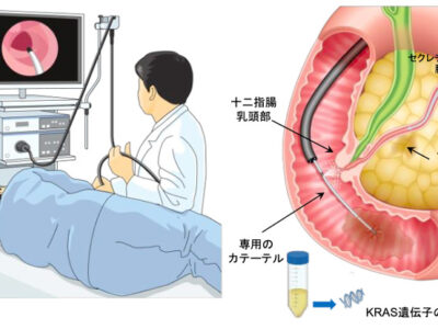 胃カメラ検査と同時に実施可能な膵臓がん早期診断法の開発