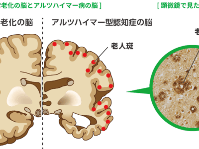 アルツハイマー病という言葉を耳にすると、多くの人が「いつか自分や家族に関わるかもしれない」と不安を覚えるのではないでしょうか。
