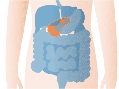 【感度90%超】早期発見が困難な「すい臓がん」のリスクを、たった3mLの尿でチェック!